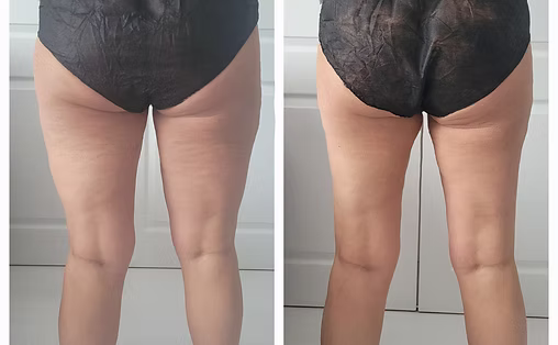 Anti Cellulite Results