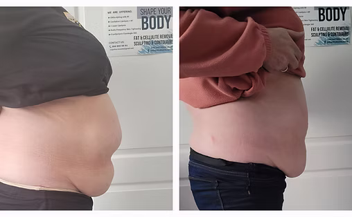 Cryolipolysis + Cavitation Results