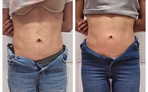 RF Skin Tightening with EMS Results