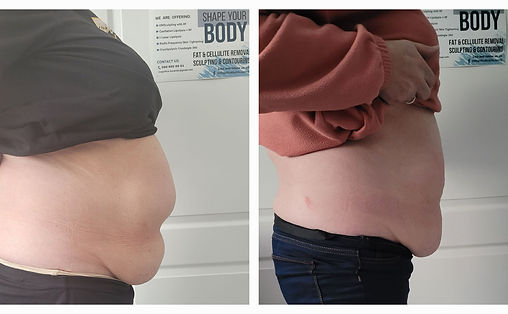 Cryolipolysis with Cavitation Liposuction